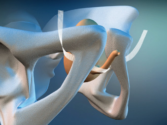 DynaMesh® SIS Direct Soft